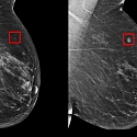 MIT CSAIL’s AI Can Predict the Onset of Breast Cancer 5 Years in Advance