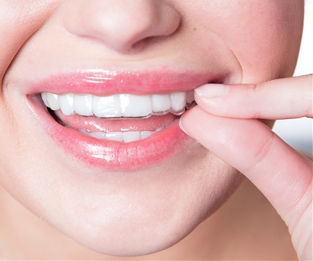 (Video) 3D Printed Dental Aligners Without Visiting The Dentist - Smile Direct Club