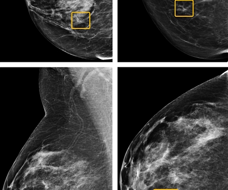 Google AI Beats Doctors at Breast Cancer Detection—Sometimes