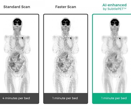 SubtlePET Artificial Intelligence Software Enhances PET Scans, Saves Time in Scanner