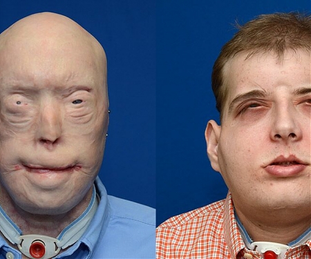(Video) World’s Most Complex Face Transplant Operation Made Possible with 3D Printing