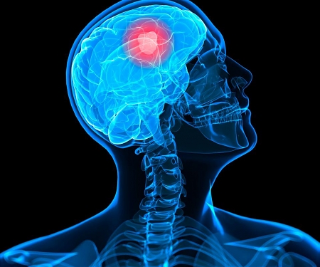 (PDF) Nvidia Develop AI System That Generates Synthetic Scans of Brain Cancer