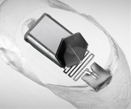 (Video) EarLens Contact Laser-based Hearing Device Receives FDA Approval