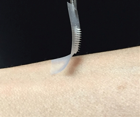 Smart Insulin Patch Could Replace Painful Injections for Diabetes
