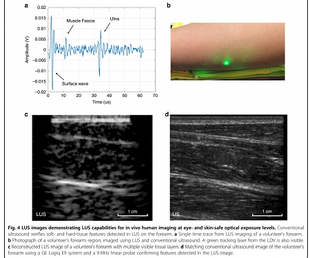 (Paper) Full Noncontact Laser Ultrasound : First Human Data