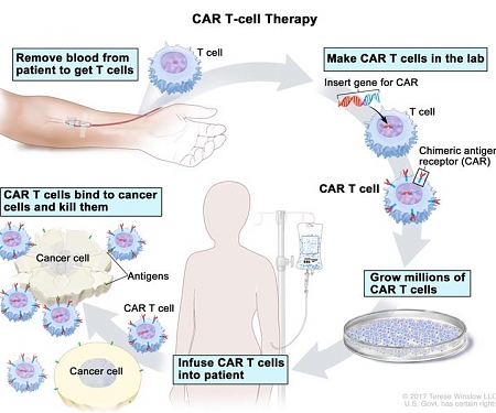 What Is Next in CAR-T Cell Therapy ?