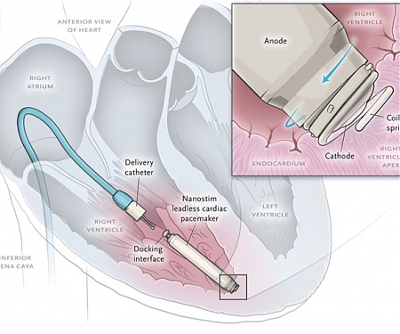 New Wireless Pacemaker Implanted Without Surgery, Found Safe in Clinical Study
