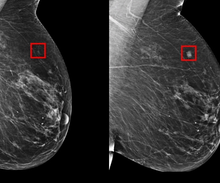 MIT CSAIL’s AI Can Predict the Onset of Breast Cancer 5 Years in Advance