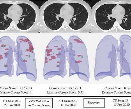 Hospitals Deploy AI Tools to Detect COVID-19 on Chest Scans
