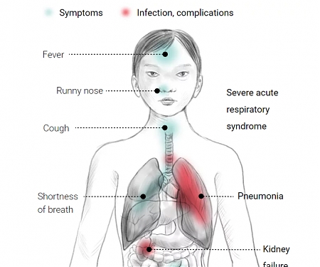 Coronavirus Overtakes Sars
