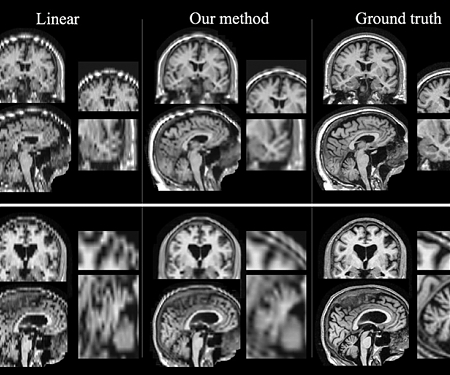 Artificial Intelligence Helps Improve MRI Imaging of Strokes