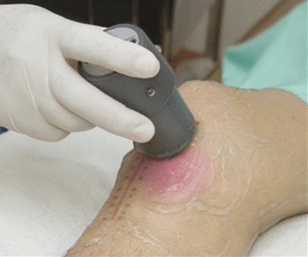 Ultrasound Wave Therapy : Promotes Healing Even For Non Ocean Swimmers