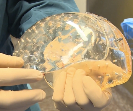 The First Transparent 3D-Printed Skull Has Been Successfully Implanted