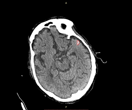 MedyMatch Raises $2M to Bring AI to Medical Imaging