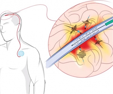 (Video) Implantable Device Translates Thought Into Action for People with Spinal Injuries
