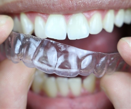 Teeth-Straightening Startup SmileDirectClub is Now Worth $3.2 Billion