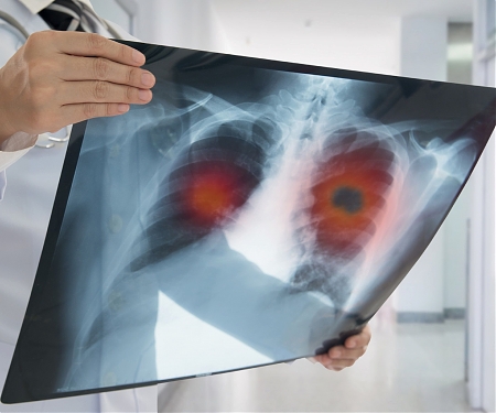 Cancer Diagnoses Rates Fell by Half During US Lockdown