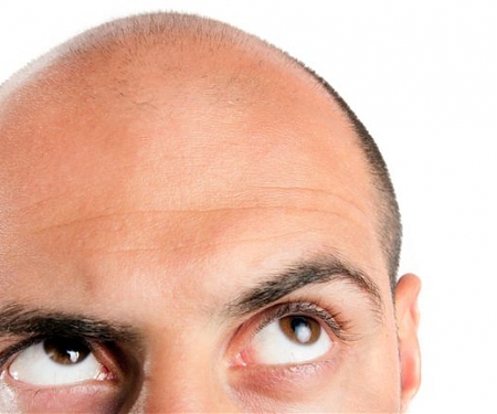 Baldness Breakthrough Uses 3D-Printed "Hair Farms" to Grow New Hair Follicles