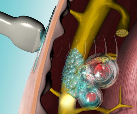 (Video) Using Ultrasound to Trigger On-Demand, Site-Specific Pain Relief