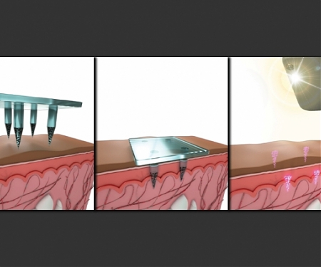 (Paper) MIT - Storing Medical Information Below the Skin’s Surface