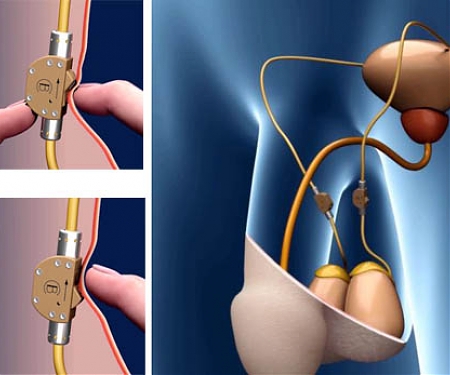 (Video) A Contraceptive Switch For Men ? Vasectomies Could Be On The Way Out