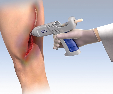 Hot Glue Gun and Custom Biocompatible Glue for Wound Closures