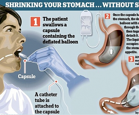 (Video) Allurion Raises $6M to Back Ingestible Weight-Loss Balloon