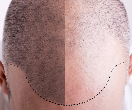 (Paper) Advance in Bulk Hair-Regrowth Technology Keeps Follicles Coming Thicker and Faster
