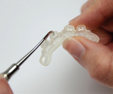 (Video) LightForce Orthodontics, Maker of 3D Printed Braces, Raises $14M