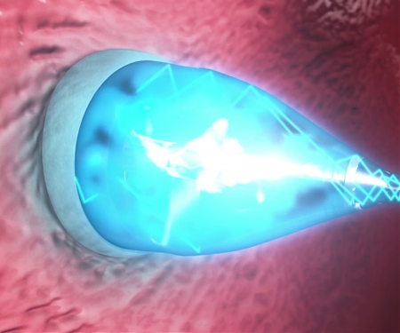 (Video) UV-Light Enabled Catheter Fixes Heart Defects Without Surgery