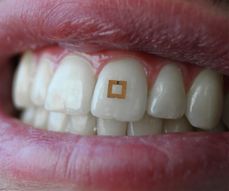Scientists Develop Tiny Tooth-Mounted Sensors That Can Track What You Eat