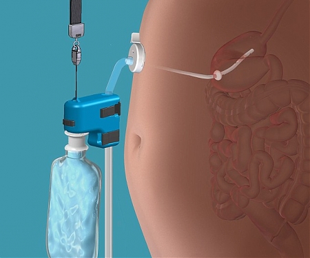 (Video) New, Reversible Weight Loss Procedure, AspireAssist FDA Approved