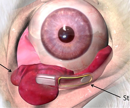 (PDF) Eye Implant for Producing Tears to Fight Dry Eye Syndrome