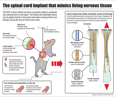Spinal Implant Could One Day Let Paralyzed People Walk Again