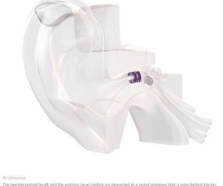 Fraunhofer & Vibrosonic - A Contact Lens for The Ear