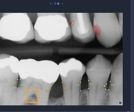Overjet Raised $42.5M for Its Dental AI Tech