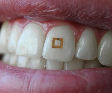 Tooth Sensors Could Be Used to Monitor Your Diet