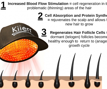 Laser Cap Therapy Might Just Be the Baldness Treatment We’ve Been Waiting For