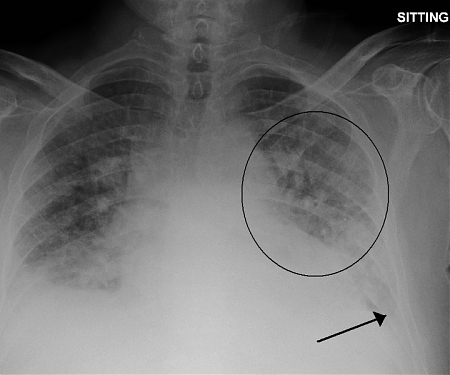 (Paper) MIT - Anticipating Heart Failure with Machine Learning