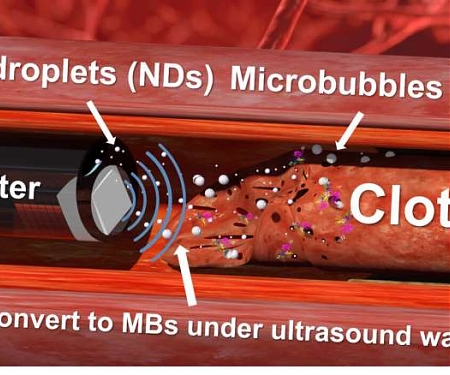 (Paper) Nanodroplets and Ultrasound 'Drills' Prove Effective at Tackling Tough Blood Clots