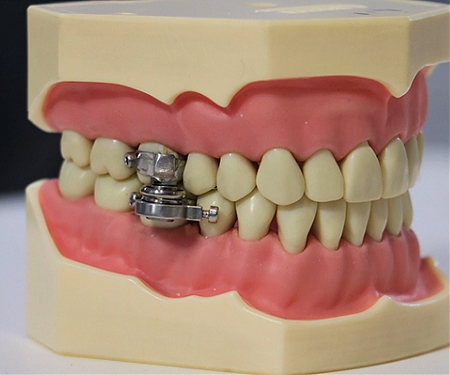 (Paper) DentalSlim Weight-Loss Device Literally Locks Your Mouth Shut