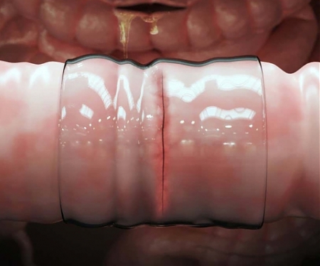 MIT Engineers Invent Surgical “Duct Tape”