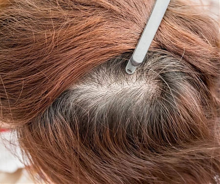 Amplifica Raises $11.8M to Help Bald People Regrow Hair