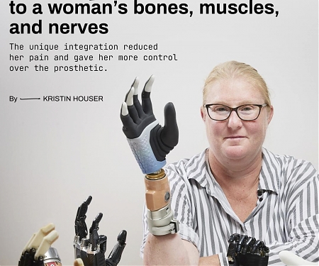 (Video) This Bionic Hand is Fused to a Woman’s Bones, Muscles, and Nerves