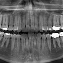 The End of Root Canals ?