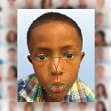 Facial Recognition Software Helps Diagnose Rare Genetic Disease