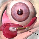 (PDF) Eye Implant for Producing Tears to Fight Dry Eye Syndrome
