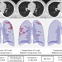 (Paper) Hospitals Deploy AI Tools to Detect COVID-19 on Chest Scans