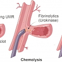 (Paper) Magnetic Microrobots Remove Blood Clots From Sheep Iliac Artery